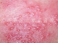 广州肤康皮肤病医院