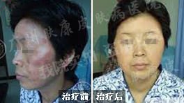 广州肤康皮肤病医院