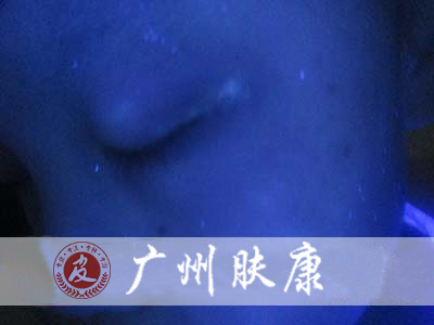 广州肤康皮肤病医院