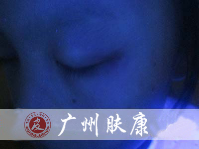 广州肤康皮肤病医院