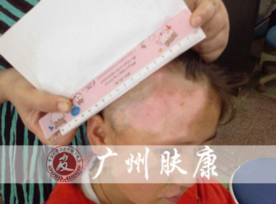 广州肤康皮肤病医院