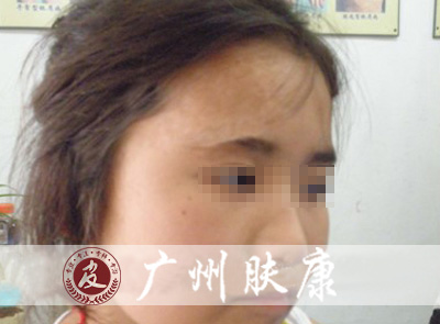 广州肤康皮肤病医院