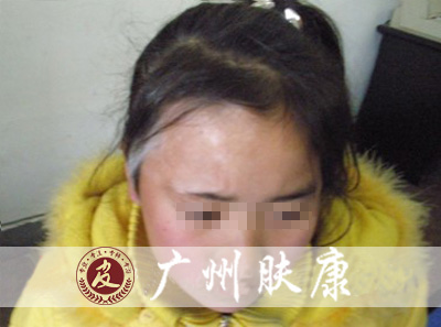 广州肤康皮肤病医院