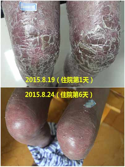 广州肤康皮肤病医院