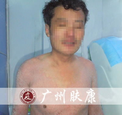 广州肤康皮肤病医院