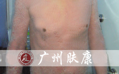 广州肤康皮肤病医院