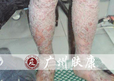 广州肤康皮肤病医院