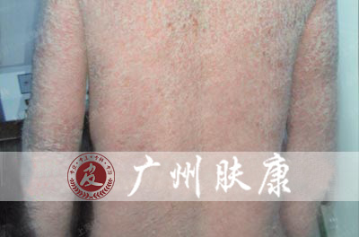 广州肤康皮肤病医院