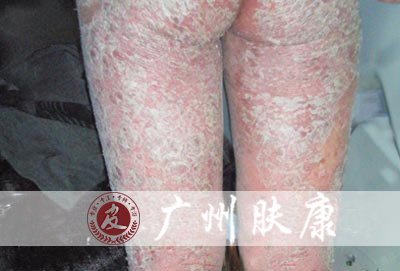 广州肤康皮肤病医院