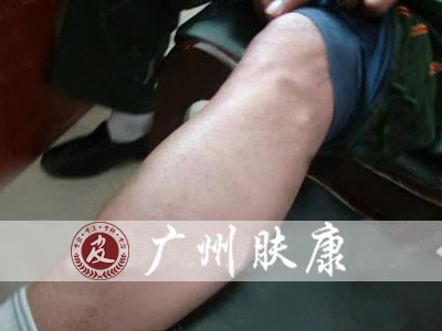 广州肤康皮肤病医院