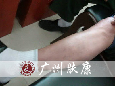 广州肤康皮肤病医院