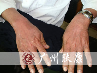 广州肤康皮肤病医院