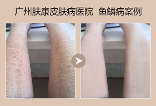 广州肤康皮肤病医院