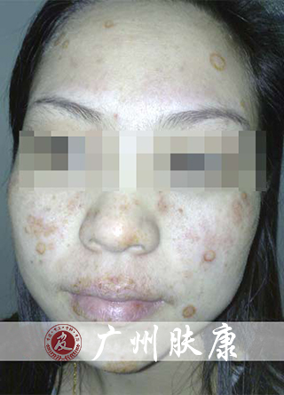 广州肤康皮肤病医院