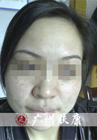 广州肤康皮肤病医院