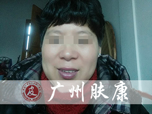 广州肤康皮肤病医院