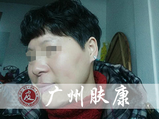 广州肤康皮肤病医院