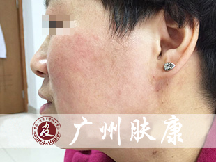 广州肤康皮肤病医院