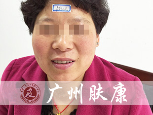 广州肤康皮肤病医院