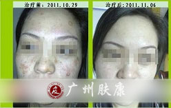 广州肤康皮肤病医院