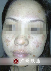 广州肤康皮肤病医院