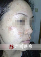 广州肤康皮肤病医院