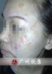 广州肤康皮肤病医院