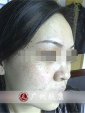 广州肤康皮肤病医院