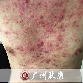 广州肤康皮肤病医院