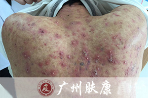 广州肤康皮肤病医院