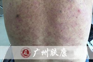 广州肤康皮肤病医院